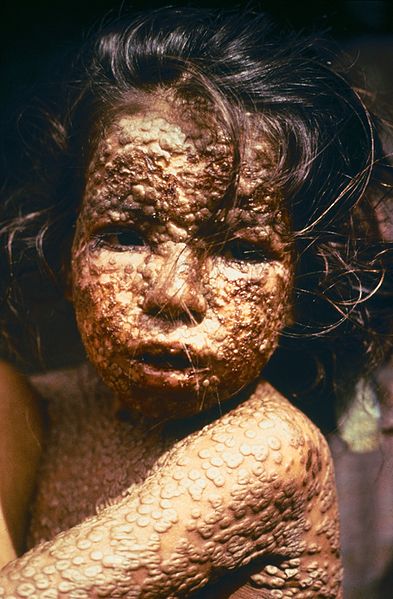 Smallpox.jpg